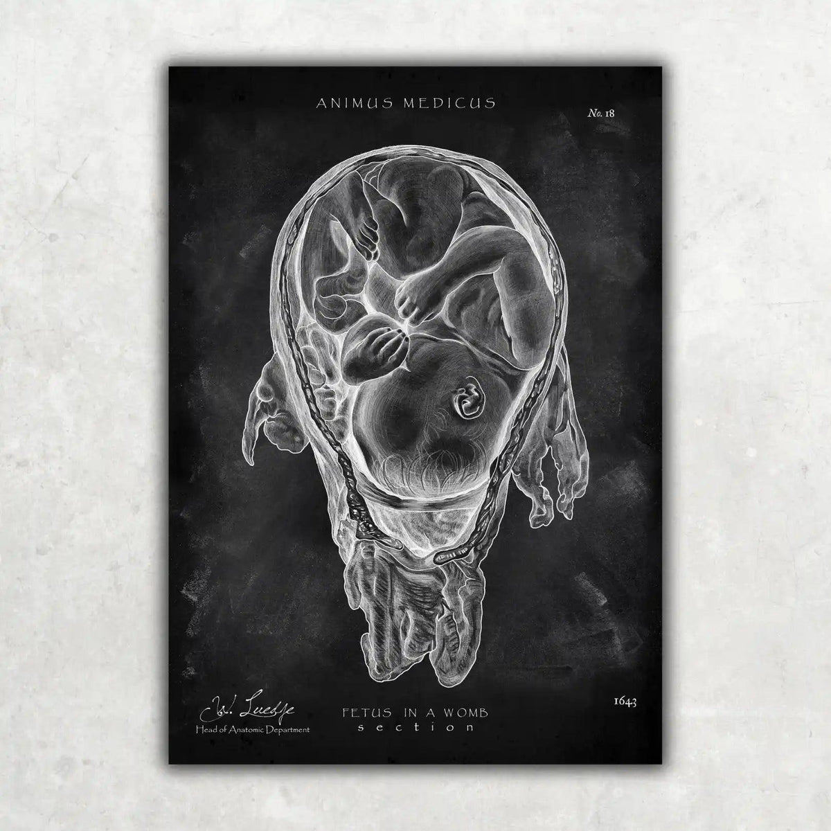 Baby in Gebärmutter - Chalkboard - Animus Medicus GmbH