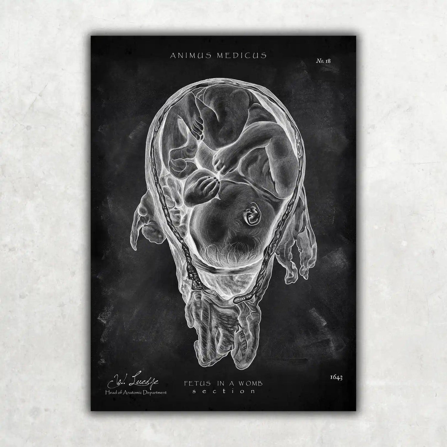 Baby in Gebärmutter - Chalkboard - Animus Medicus GmbH