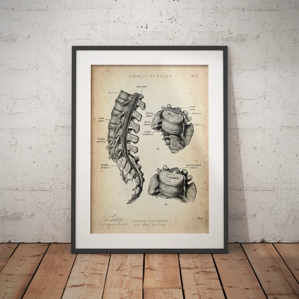 Bandscheibenvorfall Anatomie Poster - Animus Medicus GmbH