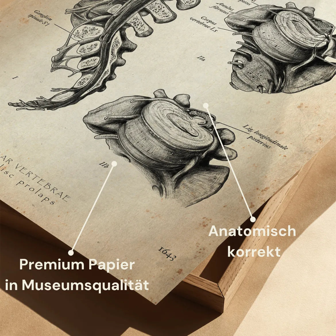 Bandscheibenvorfall Anatomie Poster - Animus Medicus GmbH