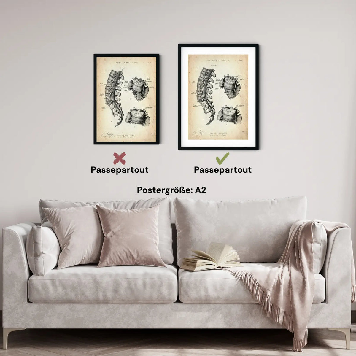 Bandscheibenvorfall Anatomie Poster - Animus Medicus GmbH