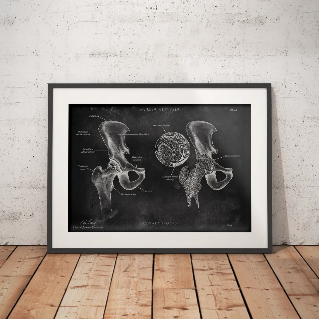 Hüftarthrose - Chalkboard - Animus Medicus GmbH