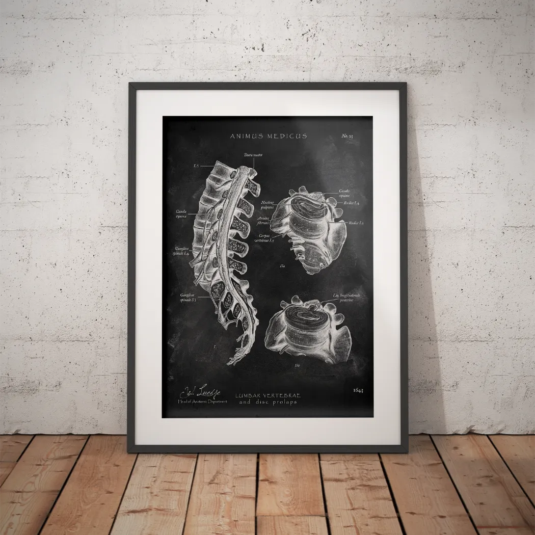 Herniated Disc Anatomy - Chalkboard