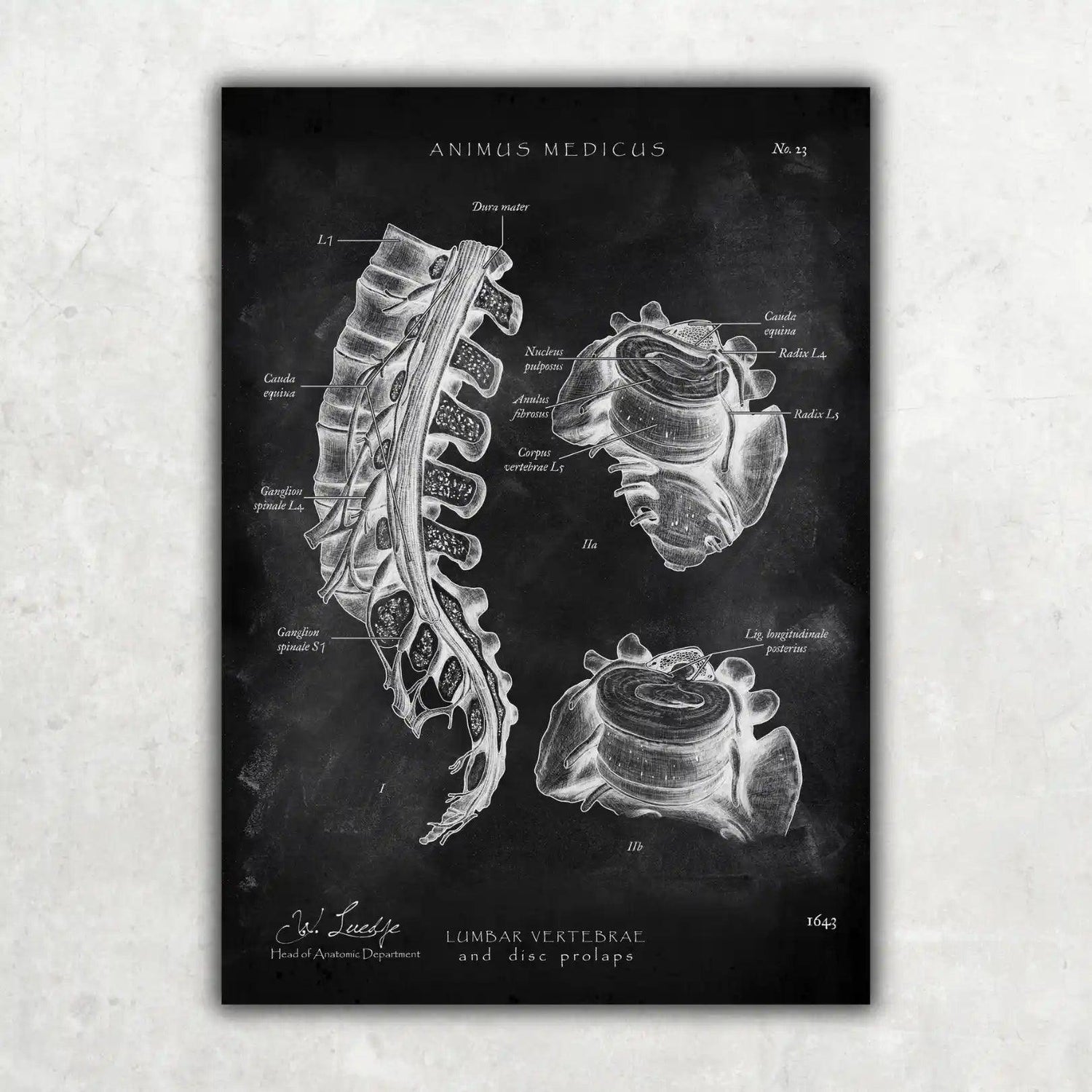 Bandscheibenvorfall Anatomie - Chalkboard - Animus Medicus GmbH