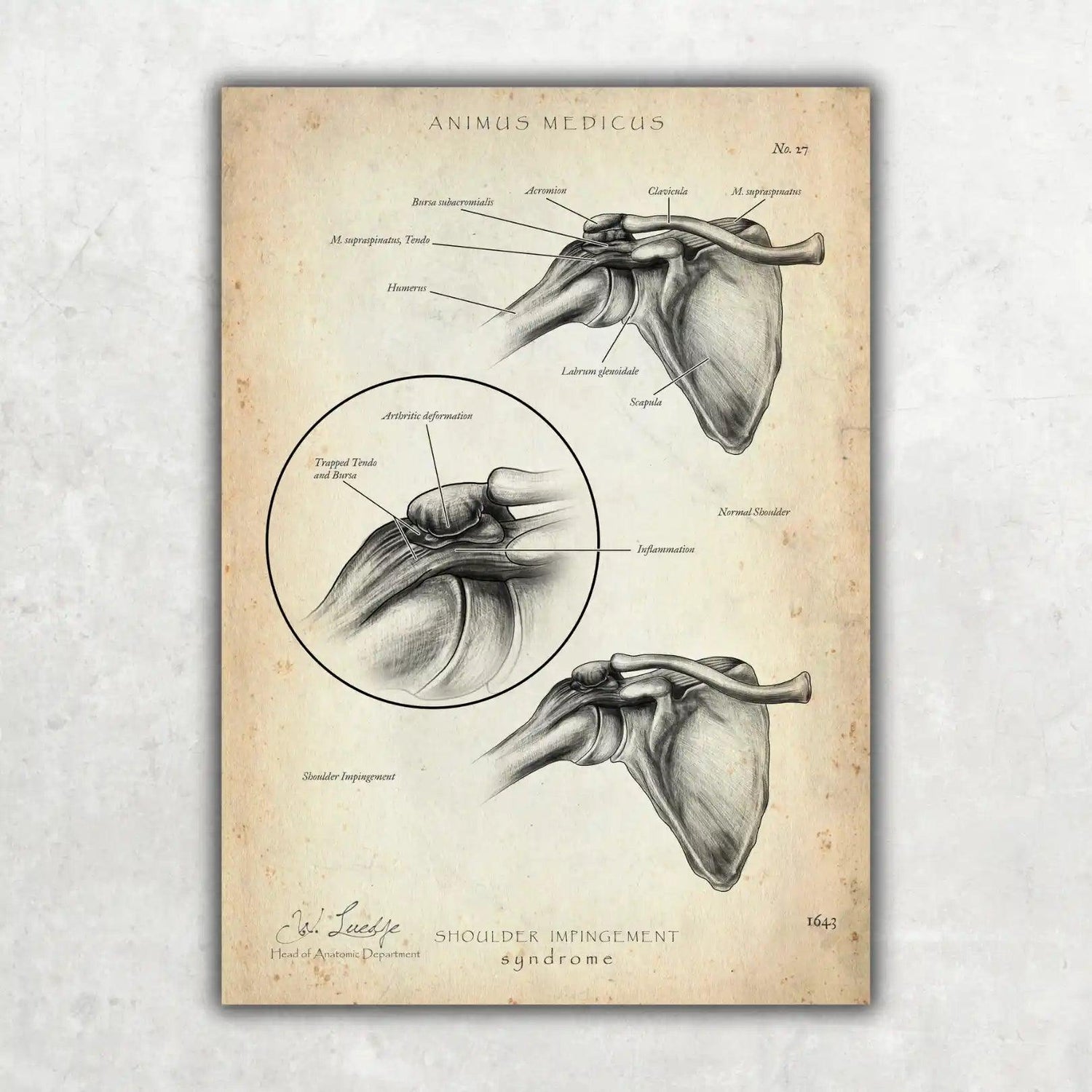 Schulter Impingement - Animus Medicus GmbH