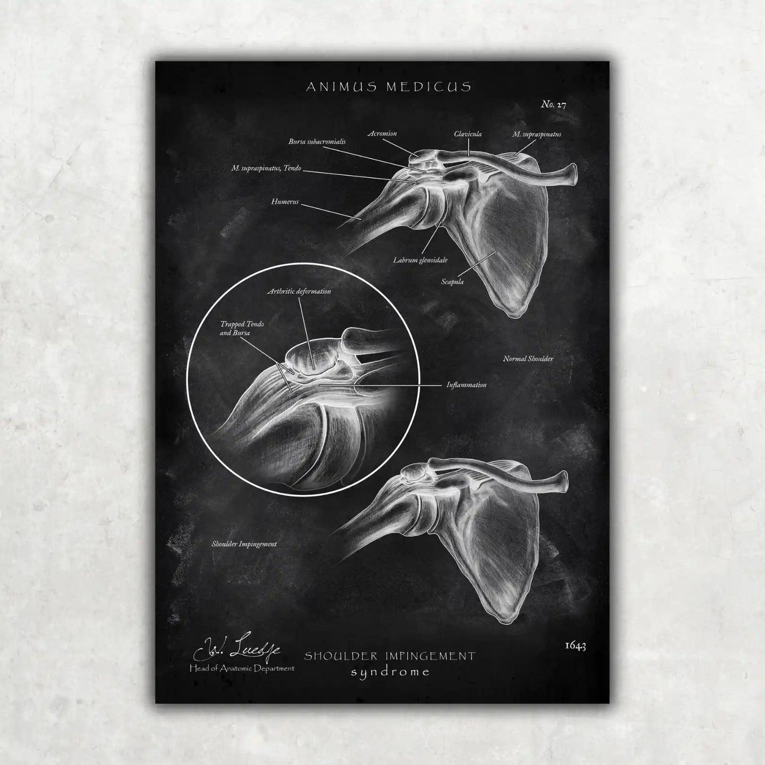 Schulter Impingement - Chalkboard - Animus Medicus GmbH